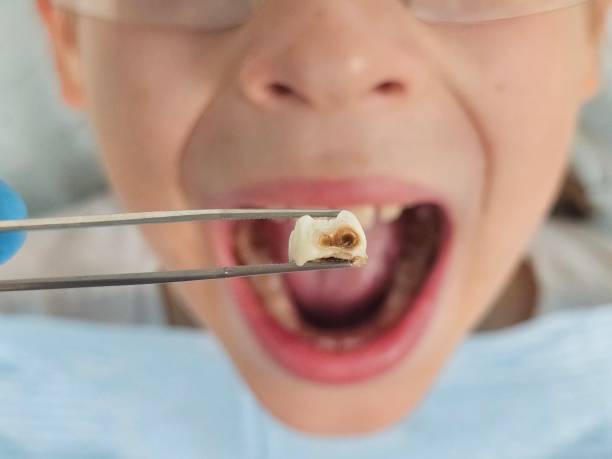 Best Knocked-Out Tooth Emergency  in Negaunee, MI